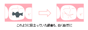 審美歯科での歯のホワイトニング辞典
