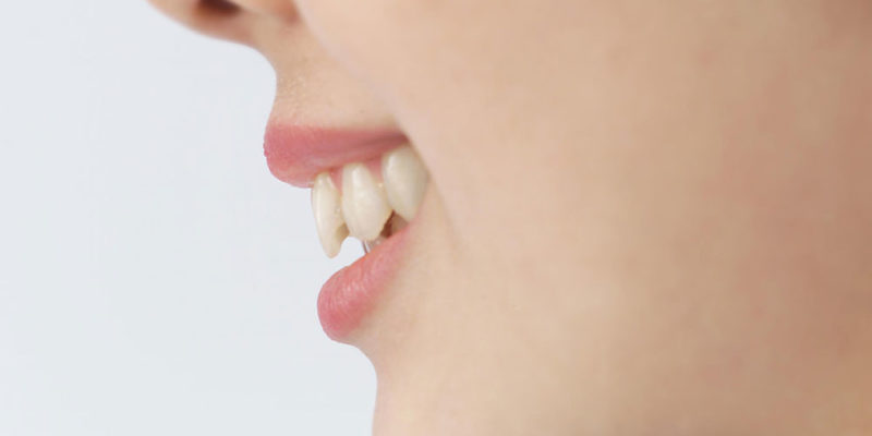 歯のしま模様と歯の表面の白い斑点 白い歯 美しい歯